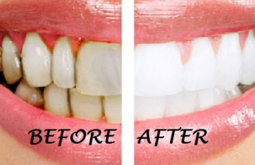 Cách làm trắng răng nha khoa việt pháp hiệu quả