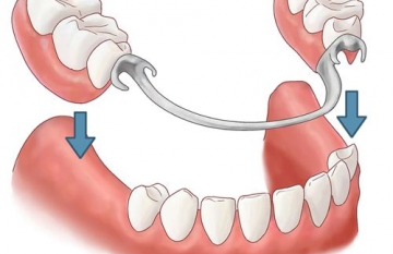 Những cách phục hình hàm răng giả tháo lắp hiện nay