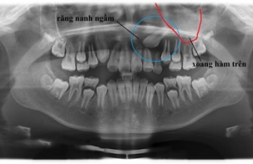 Răng mọc ngầm nên nhổ hay không?