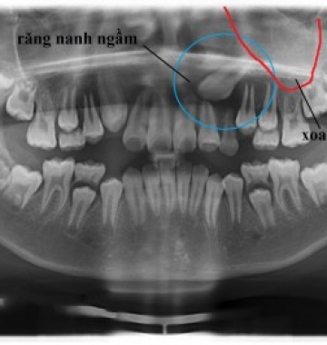 Răng mọc ngầm nên nhổ hay không?