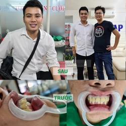 16 răng cercon ht