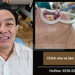 Chỉnh nha và làm răng sứ