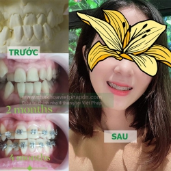 Điều trị chỉnh nha sau 4 tháng tại nha khoa việt pháp