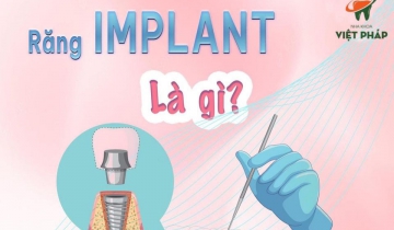 Bảng giá trồng răng Implant tại Đà Nẵng