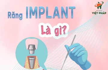 Bảng giá trồng răng Implant tại Đà Nẵng