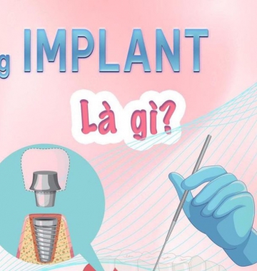 Bảng giá trồng răng Implant tại Đà Nẵng