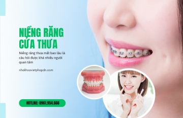 Niềng răng thưa bao lâu hiệu quả và thời gian cần thiết