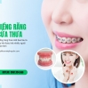 Niềng răng thưa bao lâu hiệu quả và thời gian cần thiết