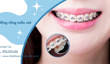 Niềng răng mắc cài bí quyết sở hữu nụ cười hoàn hảo