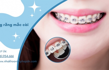 Niềng răng mắc cài bí quyết sở hữu nụ cười hoàn hảo