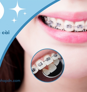 Niềng răng mắc cài bí quyết sở hữu nụ cười hoàn hảo