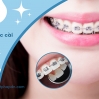 Niềng răng mắc cài bí quyết sở hữu nụ cười hoàn hảo