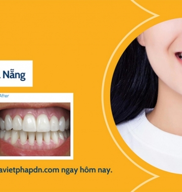 Giải Đáp Thắc Mắc Làm Trắng Răng Có Đau Không?