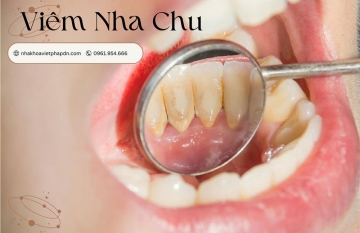 Viêm Nha Chu: Các Nguyên Nhân, Triệu Chứng và Hỗ Trợ Điều Trị Hiệu Quả