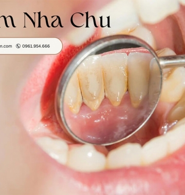 Viêm Nha Chu: Các Nguyên Nhân, Triệu Chứng và Hỗ Trợ Điều Trị Hiệu Quả