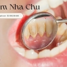Viêm Nha Chu: Các Nguyên Nhân, Triệu Chứng và Hỗ Trợ Điều Trị Hiệu Quả