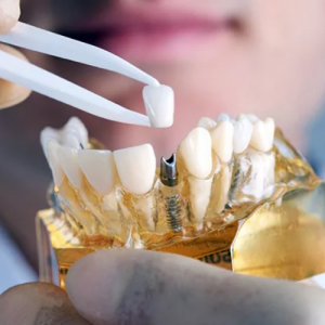 Cấy ghép implant chỉ 6,9 Triệu Cấy ghép implant chỉ 6,9 Triệu