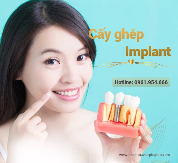 Cấy ghép Implant tại Đà Nẵng