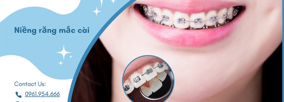 Niềng răng mắc cài bí quyết sở hữu nụ cười hoàn hảo Niềng răng mắc cài bí quyết sở hữu nụ cười hoàn hảo