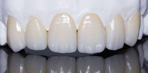 răng sứ Zirconia có tốt không?