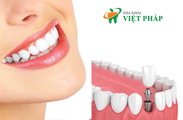 cấy ghép implant