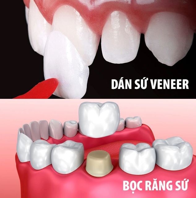 Lời khuyên bọc răng sứ thẩm mỹ địa chỉ uy tín tại Nha Khoa Việt Pháp