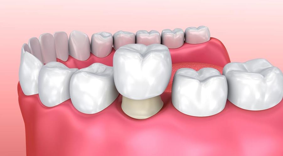 Lời khuyên bọc răng sứ thẩm mỹ địa chỉ uy tín tại Nha Khoa Việt Pháp