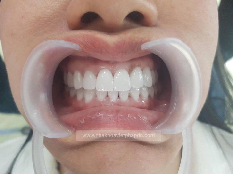 Bọc sứ răng cửa tại Đà Nẵng