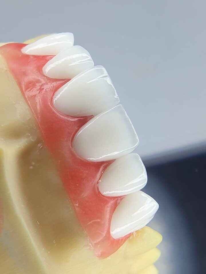 Bọc sứ răng cửa thẩm mỹ