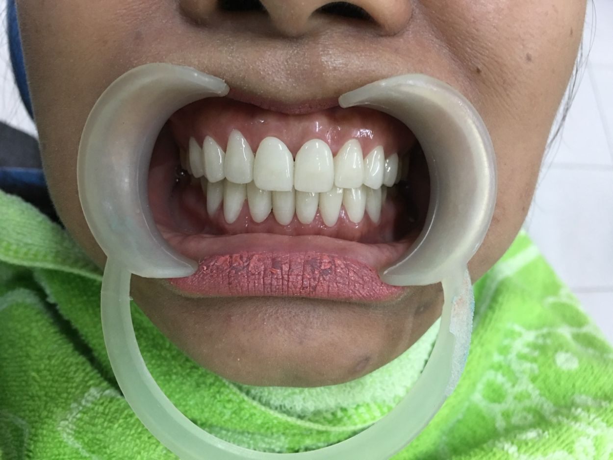 Mặt dán răng sứ Veneers nụ cười hoàn hảo