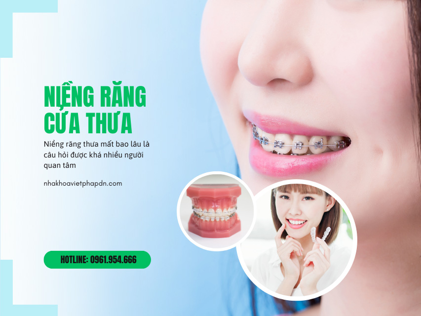Niềng răng cửa thưa