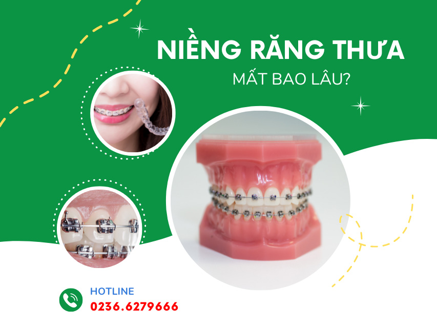 Niềng răng thưa