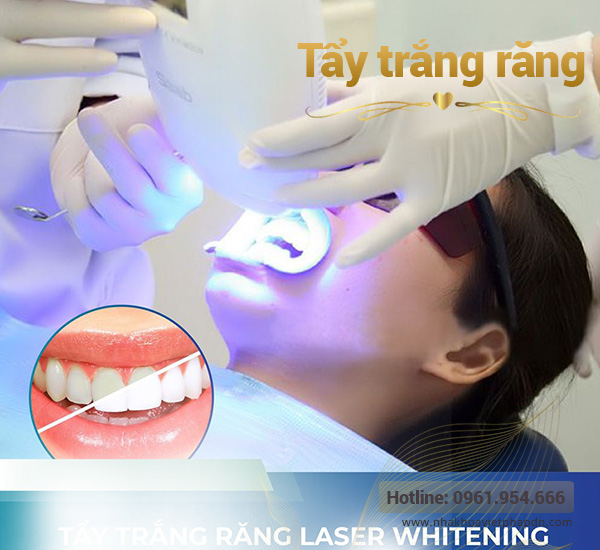 Tẩy trắng răng Đà Nẵng